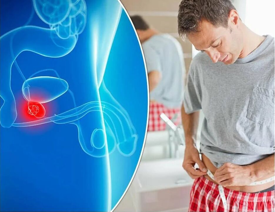simptomi i uzroci prostatitisa