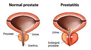 akutni prostatitis liječenje