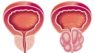 razlozi za razvoj prostatitisa i adenoma prostate